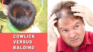 Cowlick vs Balding Is It Actually An Early Sign of Hair Loss [upl. by Ellertnom68]