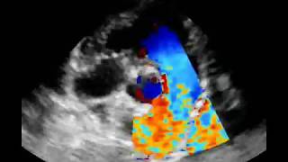 Estenosis pulmonar tipoA [upl. by Adnawak]