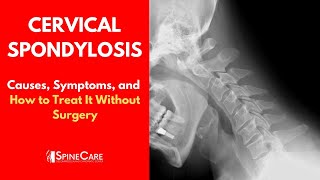 CERVICAL SPONDYLOSIS Causes Symptoms and Treatment NO SURGERY [upl. by Anila845]