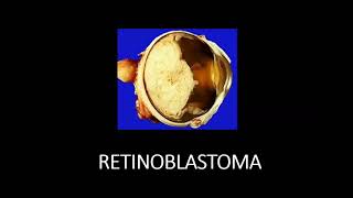 Retinoblastoma Causes  sign symptoms  Treatment  Retina [upl. by Ilonka]