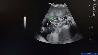 ultrasound case shows a fetus with gastroschisis [upl. by Welford]