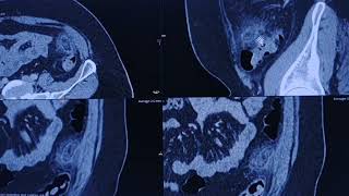 Epiploic appendagitis  CT findings [upl. by Shabbir]