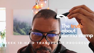 Week 18   month 4  Turkey Hair transplant The derma stamp [upl. by Melda880]