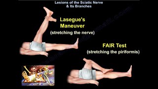 Lesions Of The Sciatic Nerve amp Its Branches  Everything You Need To Know  Dr Nabil Ebraheim [upl. by Polivy720]