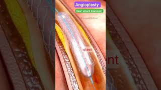 Angioplasty l स्टेंट कैसे लगाते हैं l heartattack angiography shorts [upl. by Parrott]