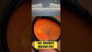 Understanding macular holes it’s a myth that there is no use treating a macular hole vitreoretina [upl. by Anelrac]