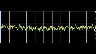 Raynauds Disease  Rife Frequencies [upl. by Bealle]