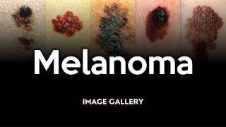 Melanoma Image Gallery [upl. by Posner]