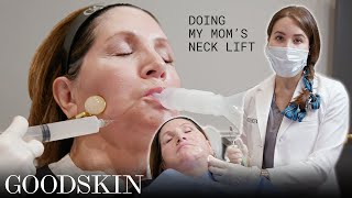 Neck Lift Procedure using AccuTite technology  GOODSKIN [upl. by Akineg]