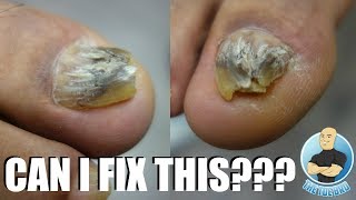 TRYING TO FIX A DAMAGED amp DEFORMED BIG TOENAIL [upl. by Oigaib]