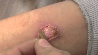 Classmate peeling burn scab [upl. by Glogau]