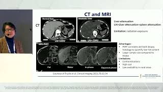 RSNA 2023  Quantitative Ultrasound Imaging to Access MASLD  Dr Jing Gao [upl. by Hudnut]