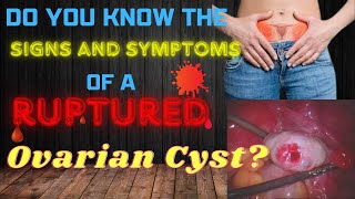 Why Do Ovarian Cysts RUPTURE What You Should Know  Cause 1 [upl. by Luigino]