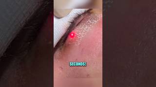 Laser Skin Tightening Machine [upl. by Earazed892]