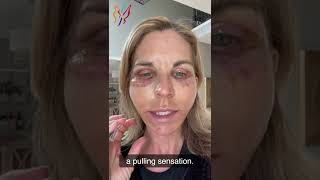 My Advanced Facelift Recovery Day by Day  Real Stories By Real Patients 2022 [upl. by Atinas97]