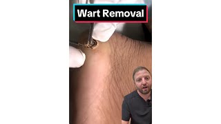 Wart Removal by Cauterizing Pain Free [upl. by Johnathan]