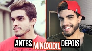 MINOXIDIL ANTES E DEPOIS  6 MESES [upl. by Bohman776]