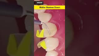 Midline Diastema Closure via Sectional Matrices with Syringe Composite method shorts viral [upl. by Nivri]