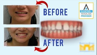 Invisalign Before and After Gap in Teeth [upl. by Ateiram]