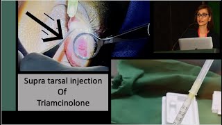 The technique of Supra Tarsal Triamcinolone injection in severe Vernal Catarrh with giant papillae [upl. by Rasec]