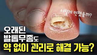 이것저것 다 해봤다 발톱 무좀 약 없이 전문관리로 해결합니다 [upl. by Moor]