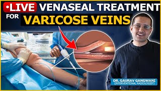 Varicose Vein Treatment Procedure  Best surgery for varicose vein treatment  Not laser ablation [upl. by Leibarg298]