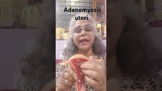 Adenomyosis of uterus health इनफॉर्मेशन [upl. by Haet570]