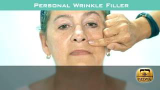 KEDMA Personal Wrinkle Filler in Action [upl. by Giannini600]