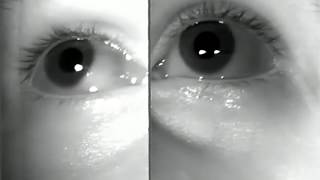 WallEyed Bilateral Internuclear Ophthalmoplegia WEBINOMoran226 [upl. by Sufur]