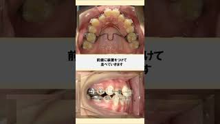 八重歯の矯正歯科治療 矯正歯科 美容 braces [upl. by Anivlis]