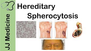 Hereditary Spherocytosis  Pathophysiology Symptoms Diagnosis and Treatment [upl. by Wagstaff]