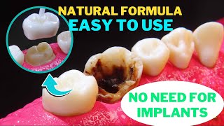 Try This “Navy ToothRepair” Hack Before Even Thinking About Implants Natural Formula  Easy To Use [upl. by Tedmund]