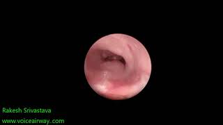 Congenital subglottic stenosis [upl. by Neelhtac559]