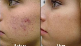 About Microdermabrasion  Before amp After Acne Scars Blackheads PMD Facial routine massage Skincare [upl. by Rosabelle]