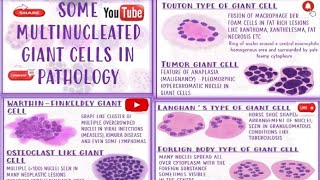 Giant Cell Type Of Giant Cell Foreign Body Giant CellTumour Giant Cell Pathology [upl. by Lettig139]