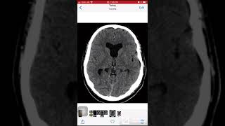 Case 078 Case Absent septum pellucidum [upl. by Hausner]