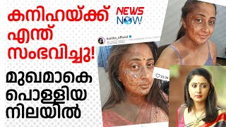 കനിഹയ്ക്ക് ഇതെന്തു പറ്റി മുഖമാകെ പൊള്ളിയ നിലയില്‍ kaniha movie actress [upl. by Lemrej855]