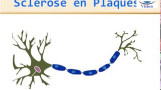 Sclérose en Plaques Physiopathologie Symptomes Diagnostic IRM traitement [upl. by Yekciv972]