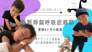 【睡眠時無呼吸症候群】の術後 6ヶ月後の経過‎🤍🫧 [upl. by Floeter633]