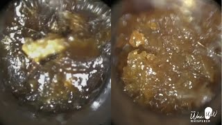 148  Unbelievable Amount of Ear Wax Removal from Crying 7 Year Old Child using the WAXscope®️ [upl. by Darrej]