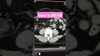 Stone in Ureter  CT KUB viral youtubeshorts shortsfeed [upl. by Calica]