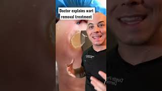 Doctor explains wart removal treatment wart dermreacts doctor [upl. by Akinek]