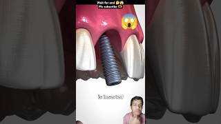 Bone Grafting Explained 🤔 nails nailart satisfying manicure dentist short ai shortvideo [upl. by Rafi]