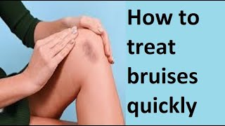 How to treat bruises quickly [upl. by Assetniuq971]