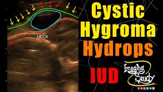 Cystic Hygroma  Hydrops Fetalis  Ultrasound  Anomaly  Case 214 [upl. by Savell873]