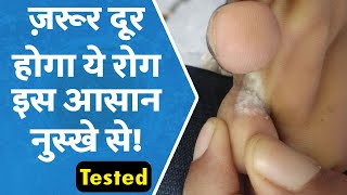 पैरों की उँगलियों के फंगस का देसी घरेलू इलाज  How to Get Rid of Athletes Foot Forever [upl. by Emelina]