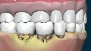 Tartaro e formazione di tasca subgengivalewmv [upl. by Schonthal]