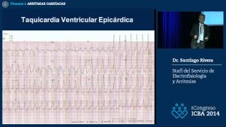 Ablación de la taquicardia ventricular Dr Santiago Rivera [upl. by Htrow]