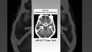 Subarachnoid Hemorrhage CT Scan viral youtubeshorts ct shortsfeed [upl. by Jacquenetta]