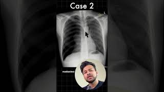 pneumoperitoneum pneumothorax emergency neetpg inicet dranujaggarwal [upl. by Chura]